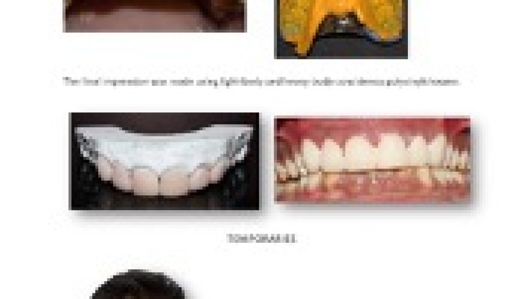 Case- Aesthetic rehabilitation of maxillary anterior teeth with dental fluorosis using all ceramic veneers