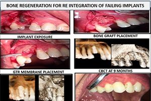 GBR surgical procedure